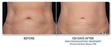 CoolSculpting Before and After Results